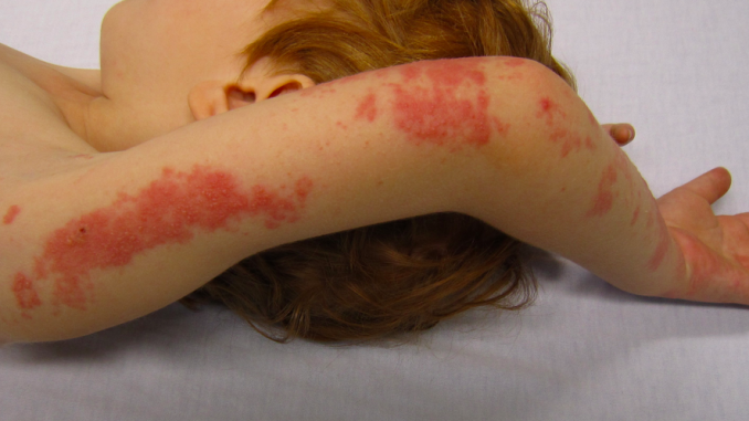 Click to enlarge chicken pox