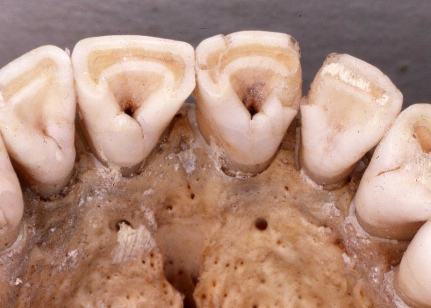 Click to enlarge incisors with significant shoveling