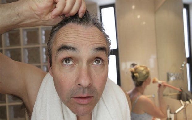 thinning hair balding men
