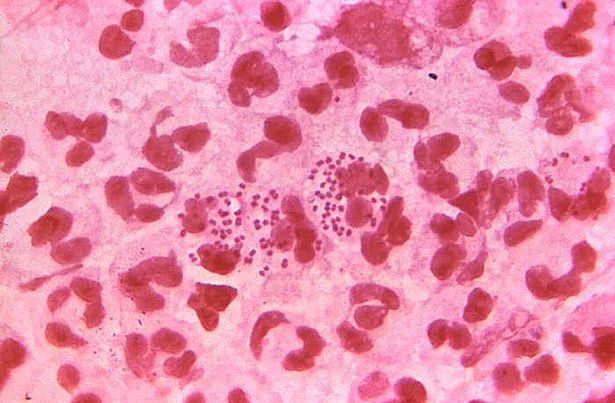 Click to enlarge Gonorrhoea