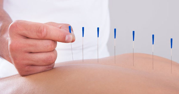 acupuncture