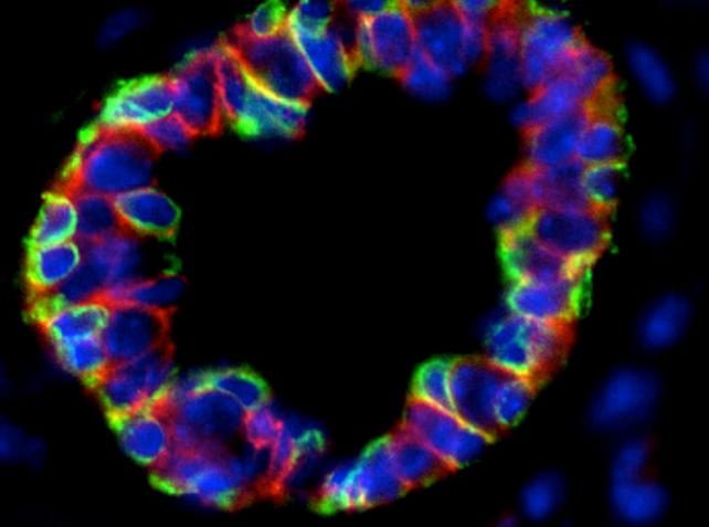 Click to enlarge breast cancer gene