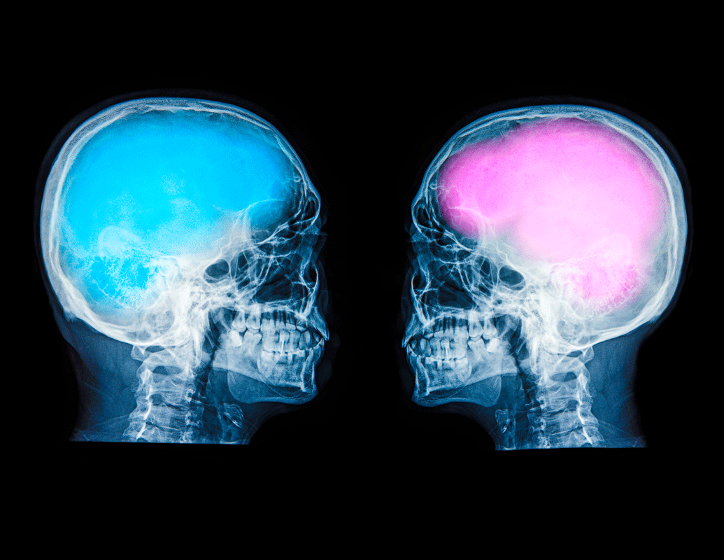 male vs female brain