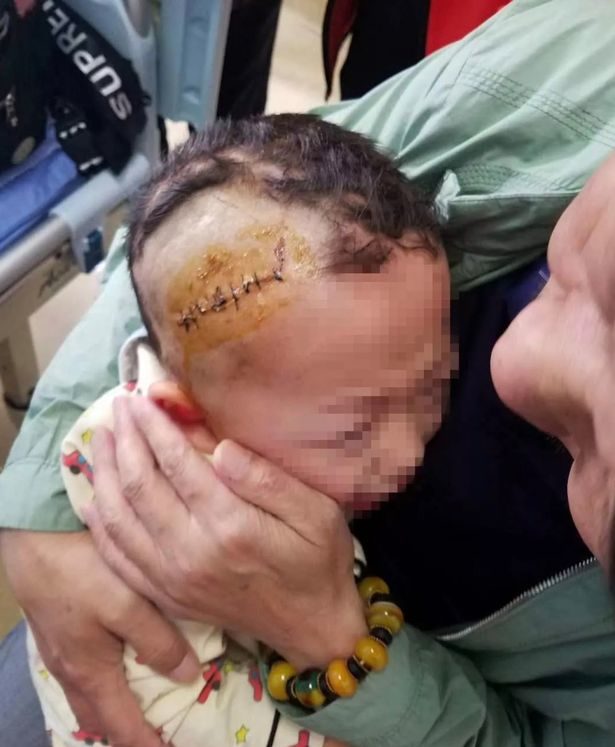 Lu Mingze, 3, had 10 stitches in his head following the dog attack