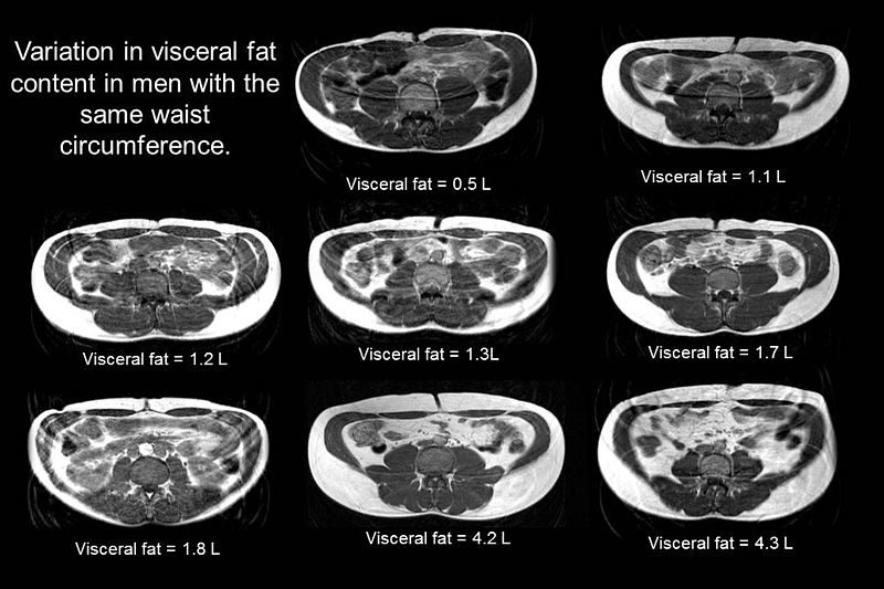 abdominal fat