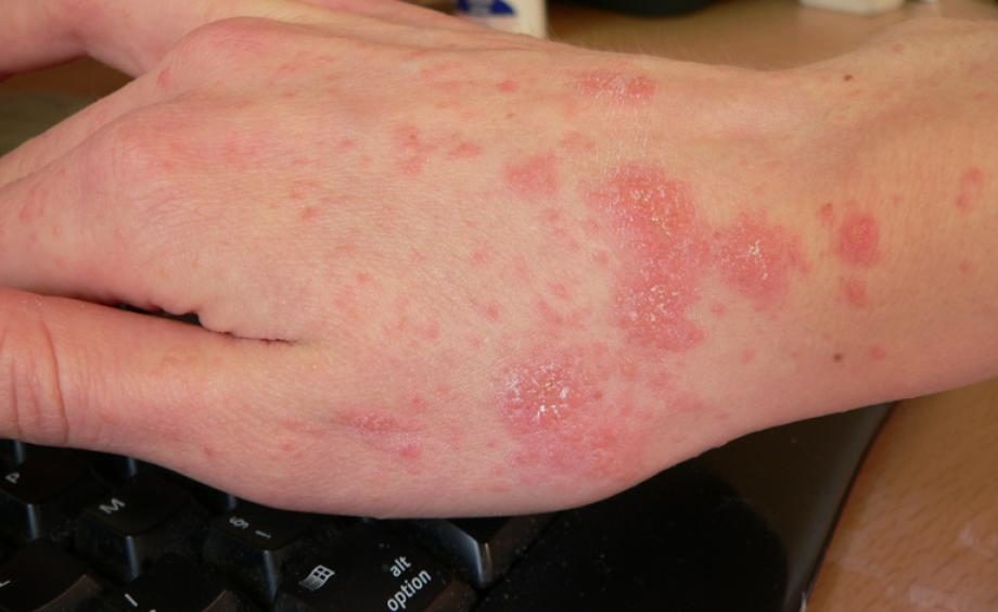 scabies
