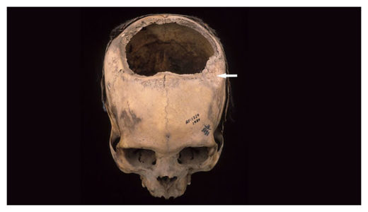 Click to enlarge Skull Surgery