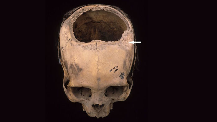 Click to enlarge Skull Surgery