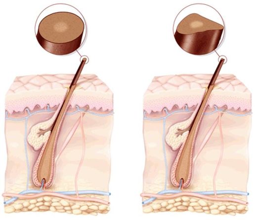 Click to enlarge uncombable hair structure