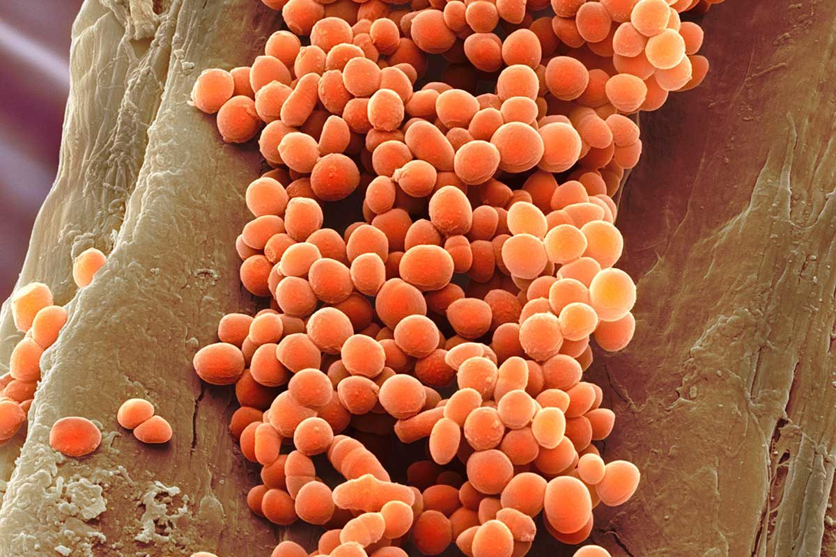 Parkinson’s disease Lactococcus gut bacteria