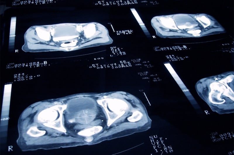 prostate cancer scan