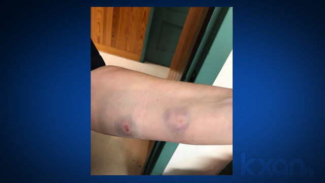 Click to enlarge Cpl. Alex Fidler was bitten during an attack by three dogs. She shot two of them June 14, 2018