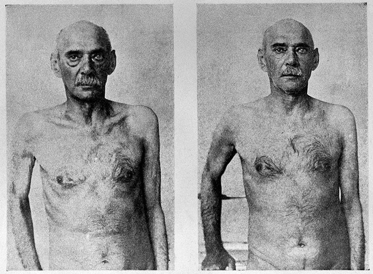 Click to enlarge Vasectomy before after