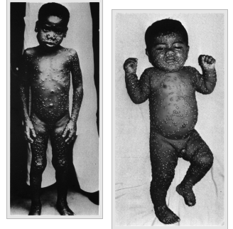 Click to enlarge Monkey pox