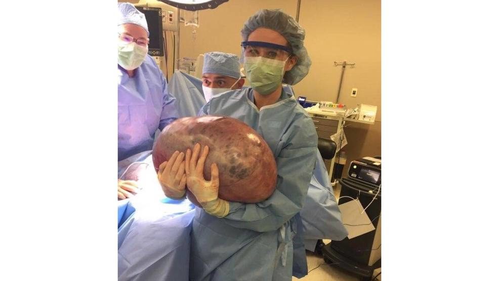 50 pound cyst