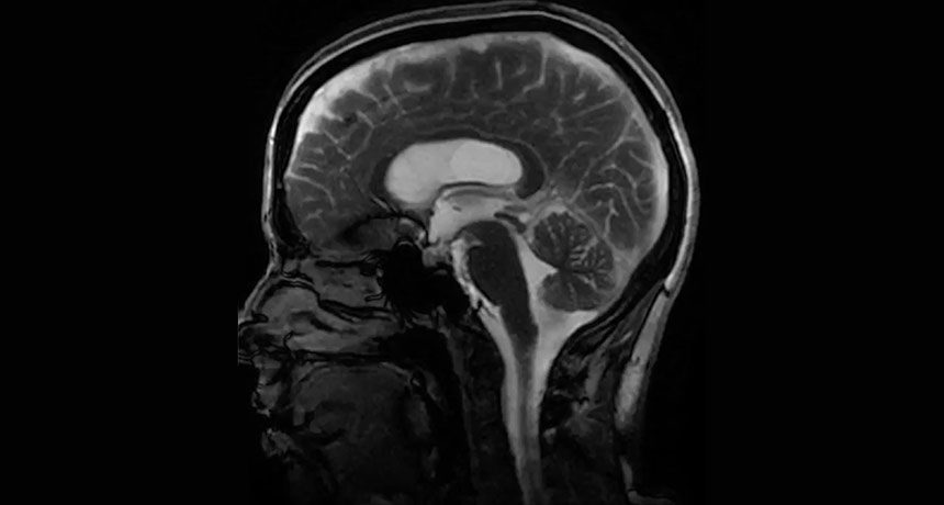 Click to enlarge brain scan