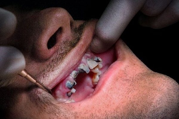 Click to enlarge meth mouth