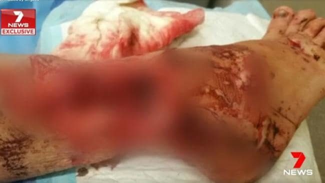 A West Australian fly-in-fly-out worker might have to have her leg amputated after being mauled by a pack of dingoes.