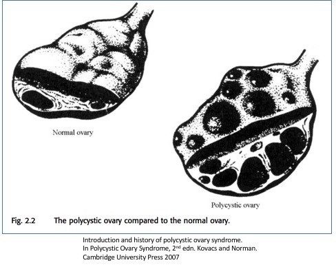 Click to enlarge Ovaries with/without PCOS