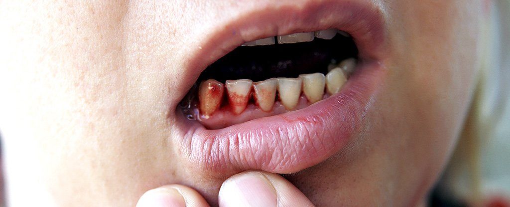 Click to enlarge gum disease scurvy