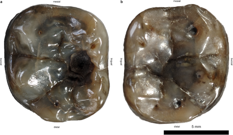 Tooth with Cavity