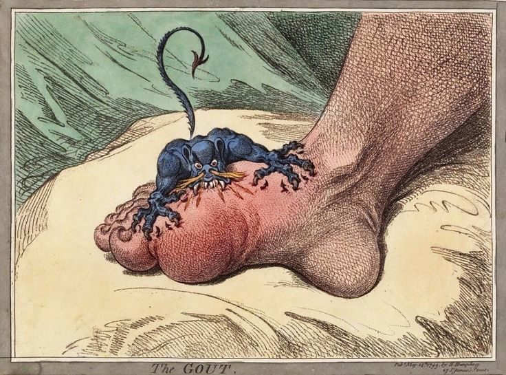Click to enlarge gout illustration