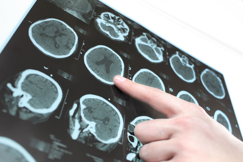 calcium supplements brain lesions