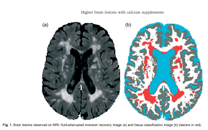 MRI brain tissue calcification