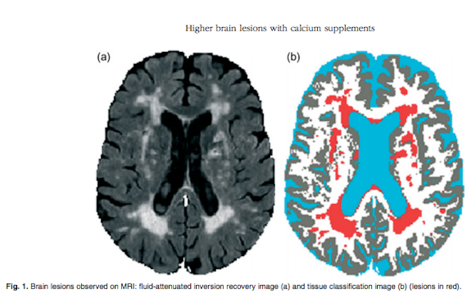 Click to enlarge MRI brain tissue calcification