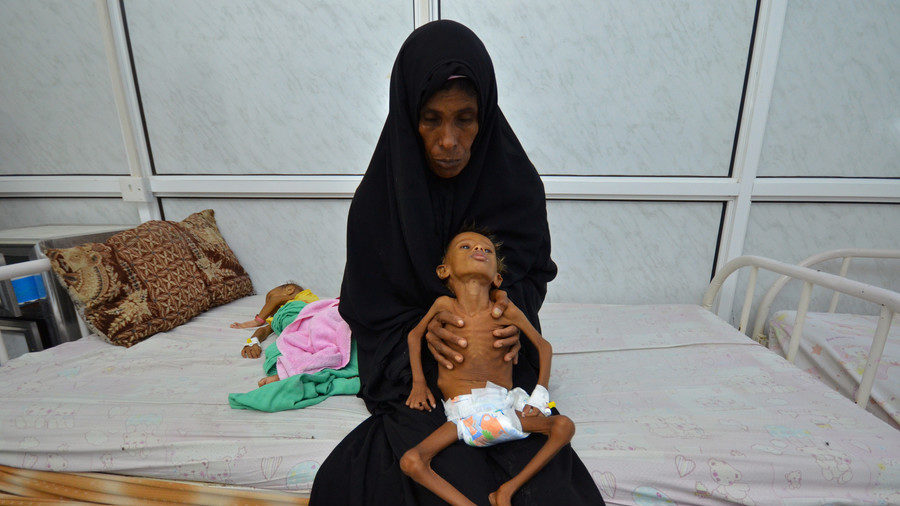 Click to enlarge Yemen malnutrition baby