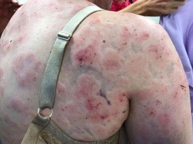 Click to enlarge Fiona Simpson was left battered and bruised following a hail storm