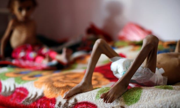 Malnourished boys in a malnutrition treatment centre in Sana’a Yemen