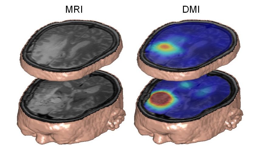 Click to enlarge MRI DMI