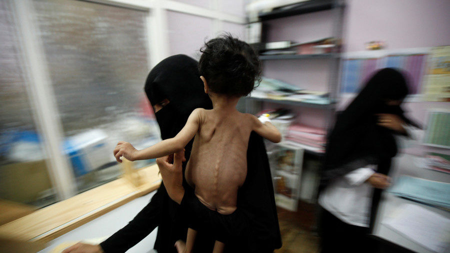 Yemen emaciated child