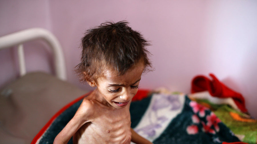 starving yemen boy