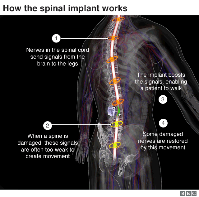 spinal implant