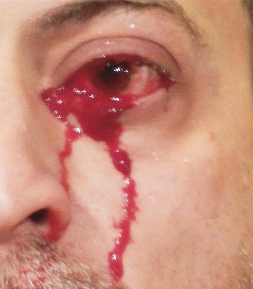 Italian man bleeding from his eyes