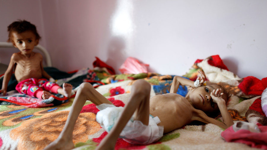 Click to enlarge starving Yemeni children war