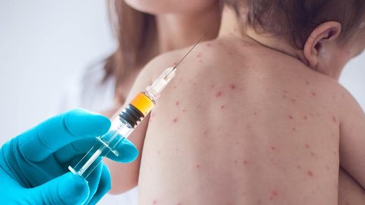 measles vaccine
