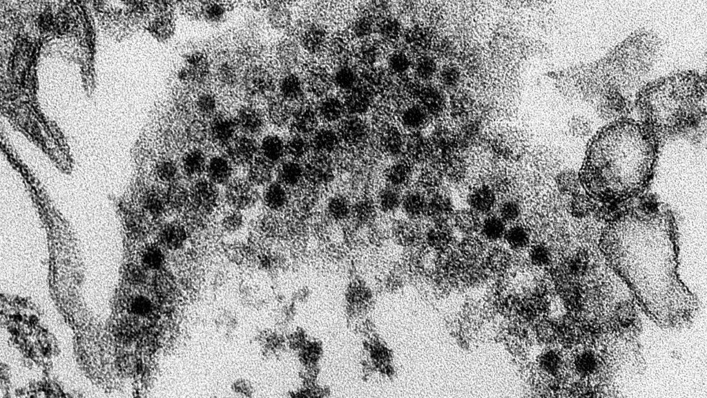 Click to enlarge enterovirus D68