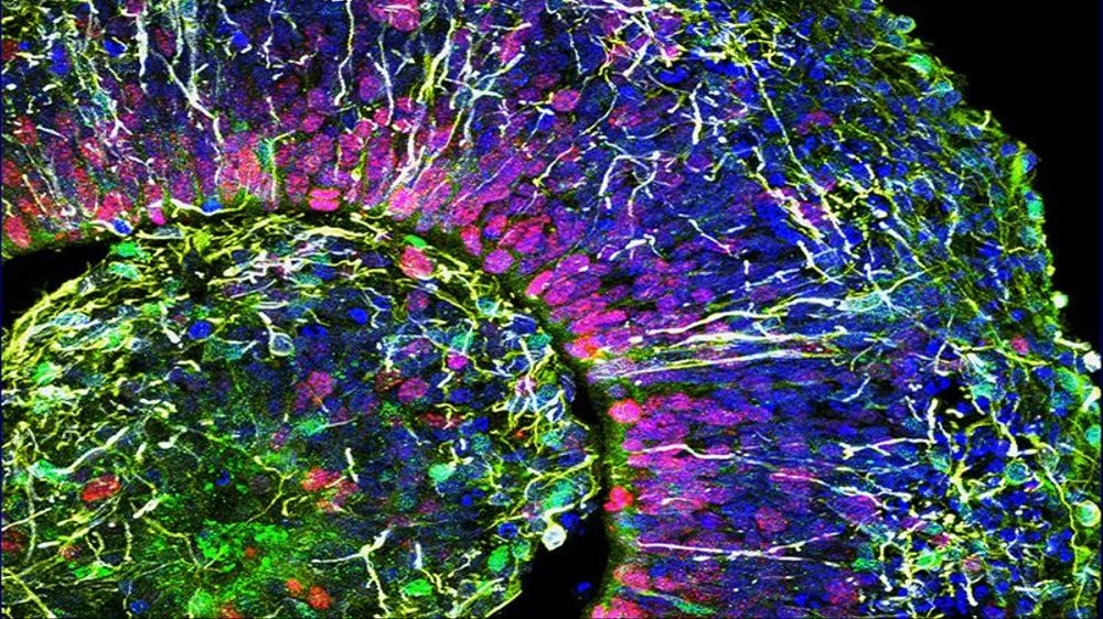 Slice thru brain