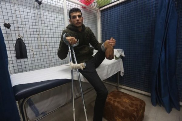 amputated limb