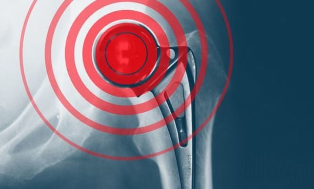 hip replacement