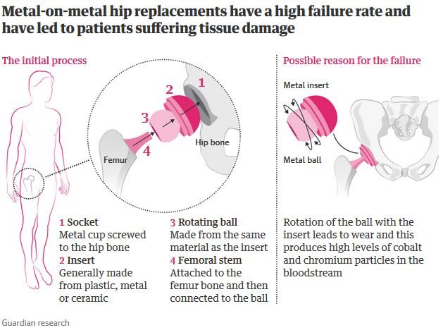 hip replacement