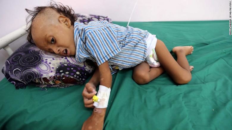 Yemeni malnutrioned child