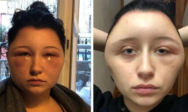 Disfigured woman