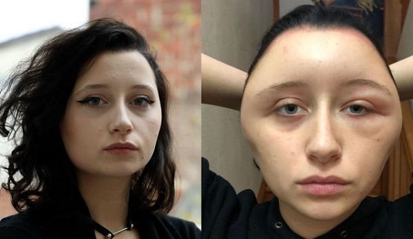 Hair dye cause disfigurement in woman