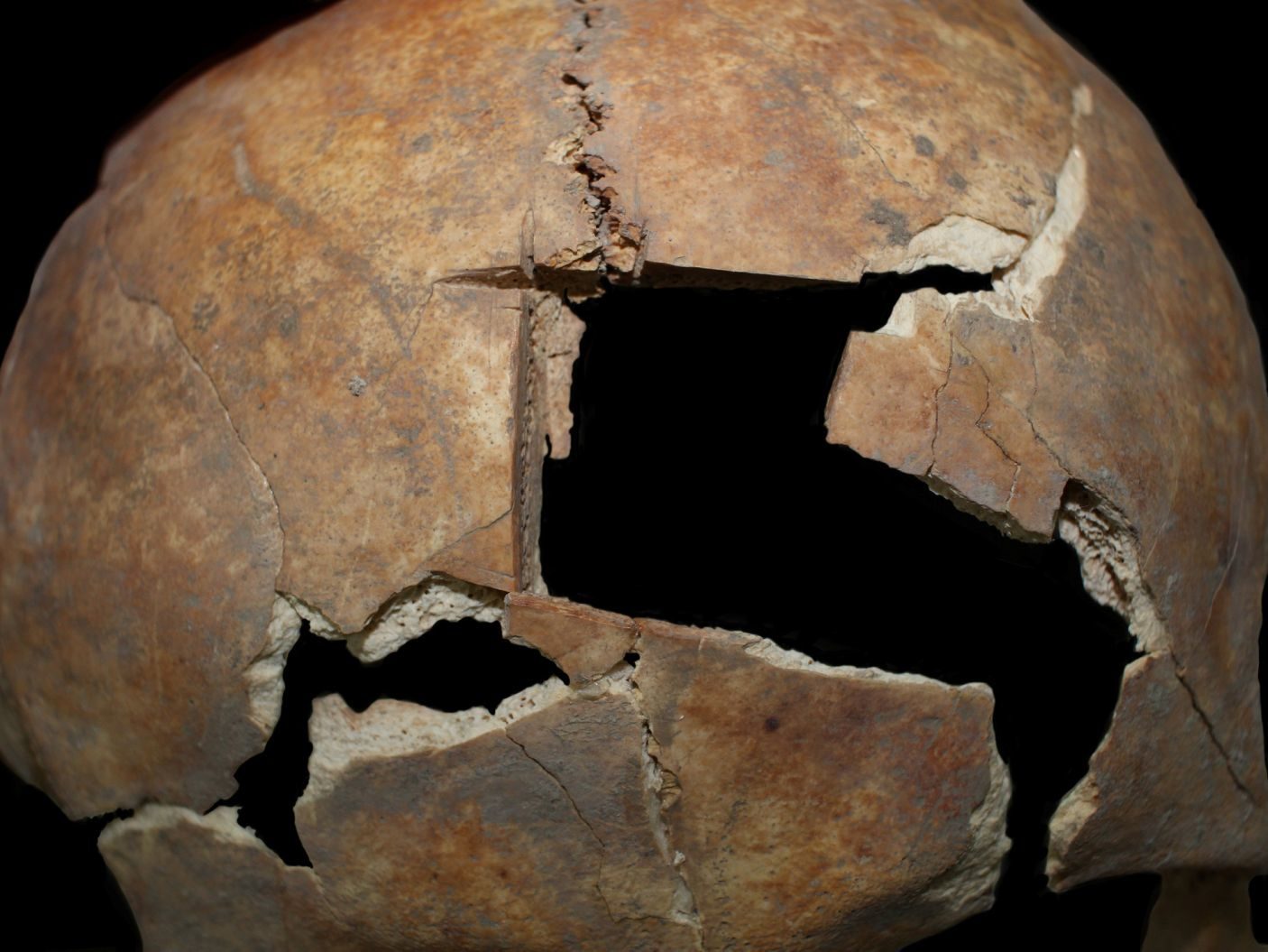 trephinated skull