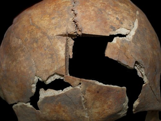 Click to enlarge trephinated skull
