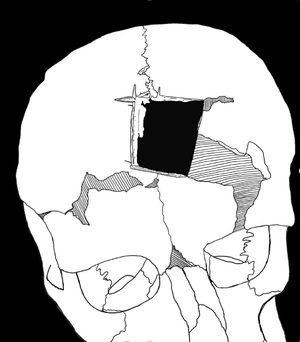 trephinated skull